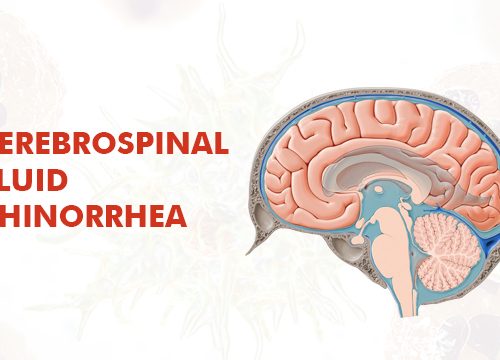 Cerebrospinal Fluid Rhinorrhea FAQ’s by Dr. Karan Aggarwal