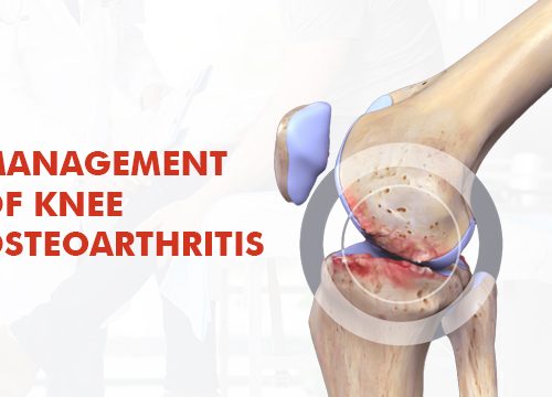 Management of Knee Osteoarthritis By Dr. Manish Bansal