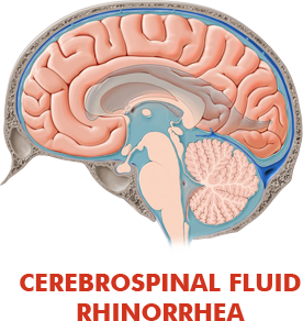 cerebrospinal fluid