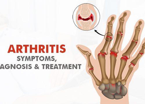 Arthritis: Symptoms, Diagnosis & Treatment