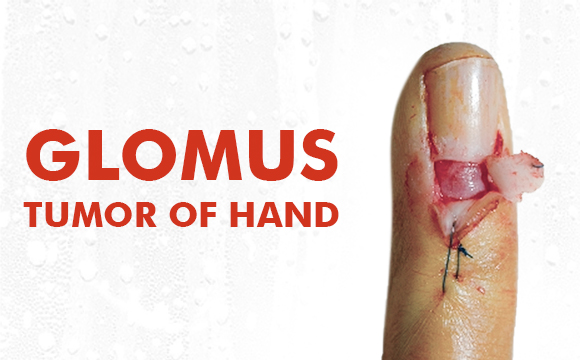 Glomus tumor of hand